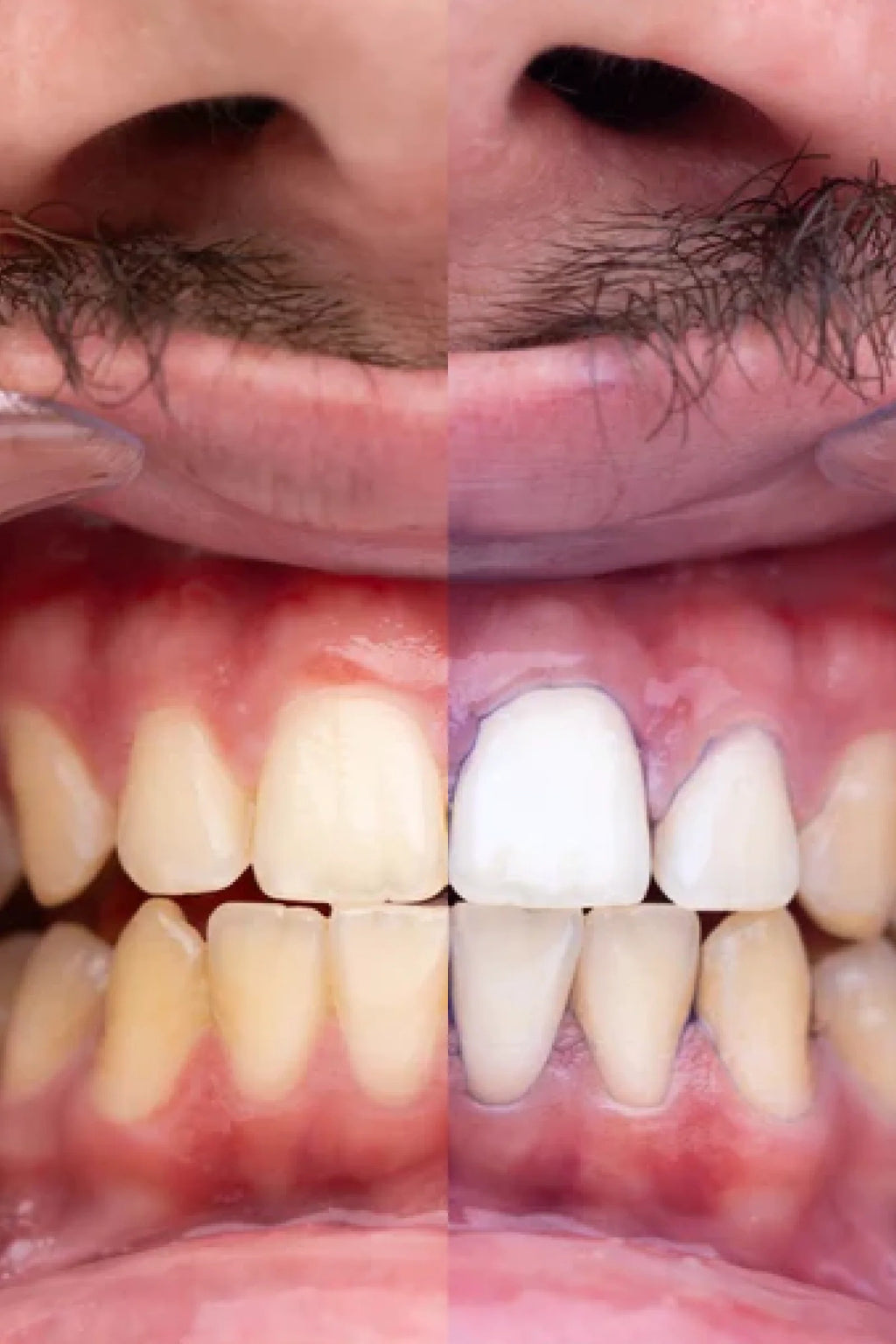 PURPLE V34 - Teeth Whitening Gel