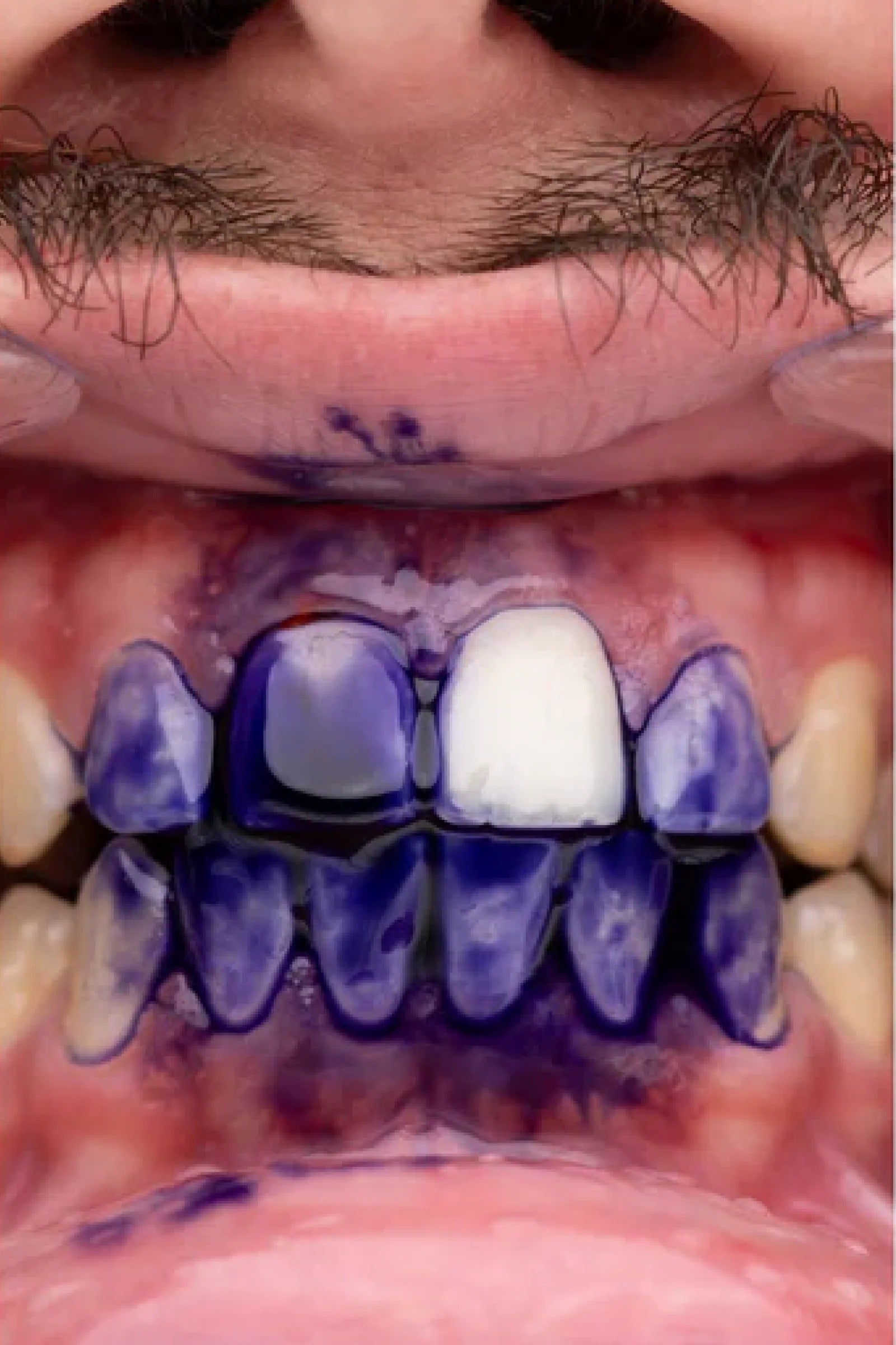 PURPLE V34 - Teeth Whitening Gel